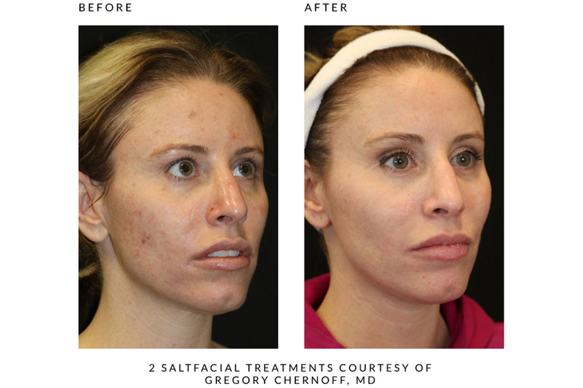 Salt Facial in Mystic, CT Cure Med Spa