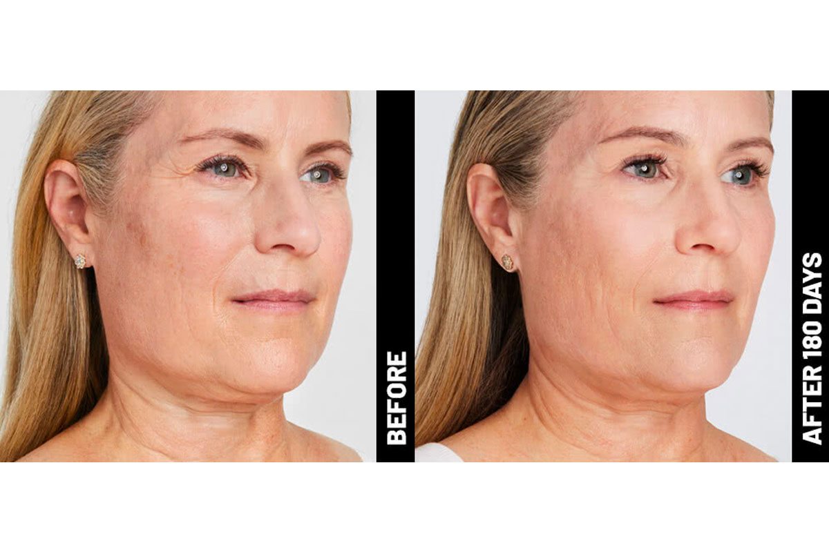 Ultherapy in Mystic, CT Cure Med Spa