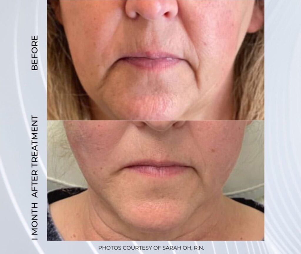 PDO Threads in Connecticut | Cure Med Spa